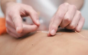 A patient at Physio Physique is undergoing dry needling therapy on back.